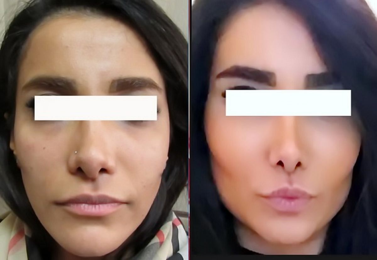 زاویه سازی صورت